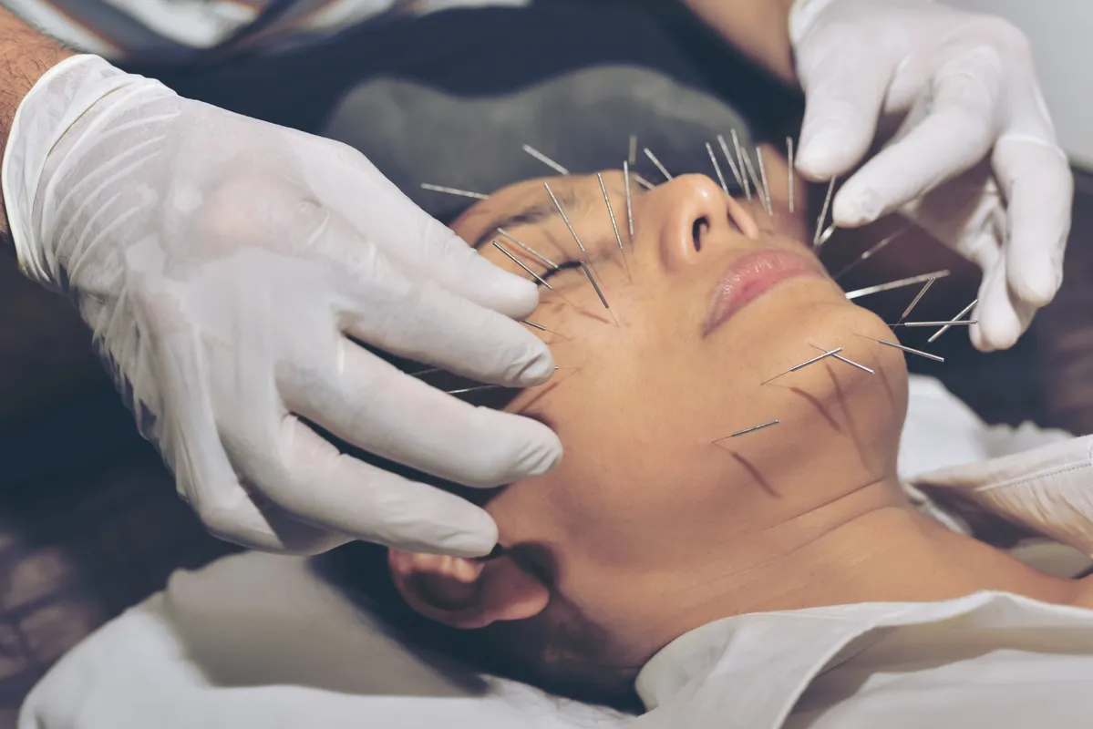 Face acupuncture.  Asian Woman undergoing acupuncture treatment.